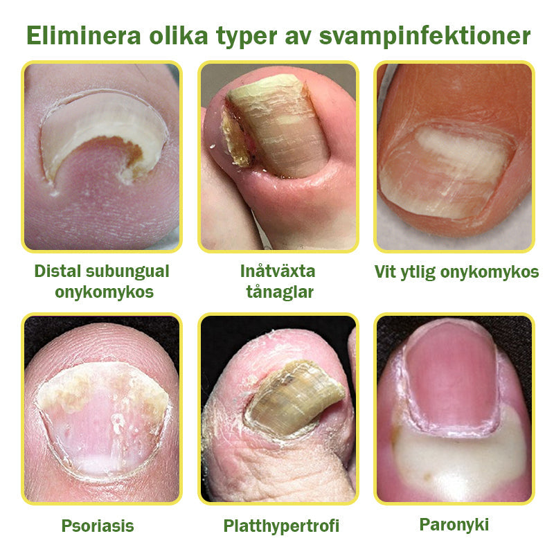 đšââïžFurzeroâą Nagelförsvar Bivensbehandlingsserum(För alla typer av nagelsjukdomarâ
För hÀlsosammare nageltillvÀxt)
