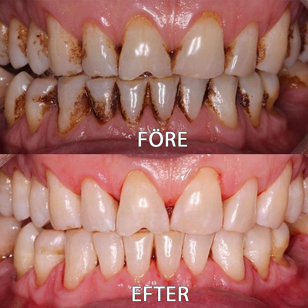 â
đšđ»ââïžOfficiell butik | Ourlyardâą Tooth Health Mineral Powderđšđ»ââïžHar erhĂ„llit certifiering frĂ„n LĂ€kemedelsverket (Behandlar parodontit och munsĂ„r, förhindrar tandförlust och reparerar tillbakadraget tandkött)