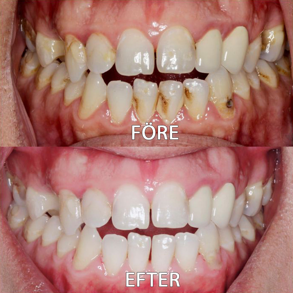 â
đšđ»ââïžOfficiell butik | Ourlyardâą Tooth Health Mineral Powderđšđ»ââïžHar erhĂ„llit certifiering frĂ„n LĂ€kemedelsverket (Behandlar parodontit och munsĂ„r, förhindrar tandförlust och reparerar tillbakadraget tandkött)