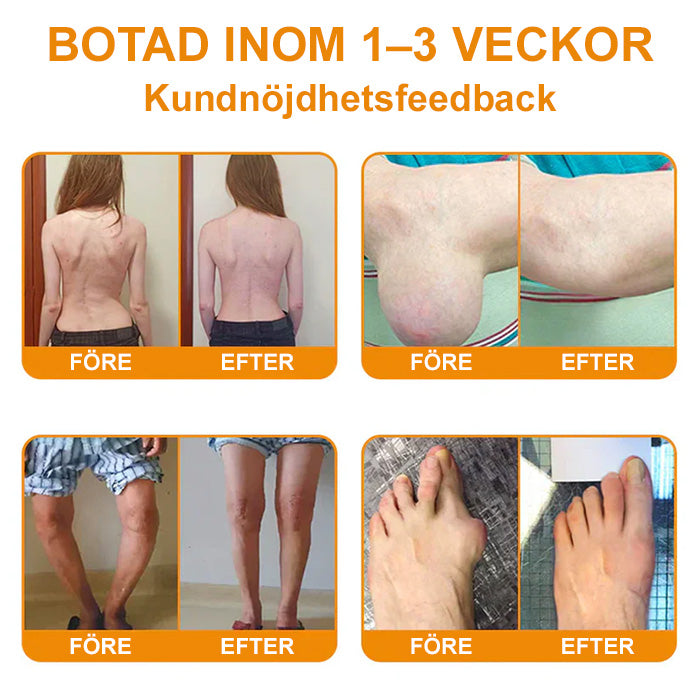 ✅Officiell butik: flysmus™ Bee-Venom Pain-Relief Bone Healing Cream👨⚕️ Godkänd av Svenska Ortopediska Föreningen (SOF) (Minskar ledvärk, rodnad,svullnad, stelhet,värme, ömhet och ledtrötthet)