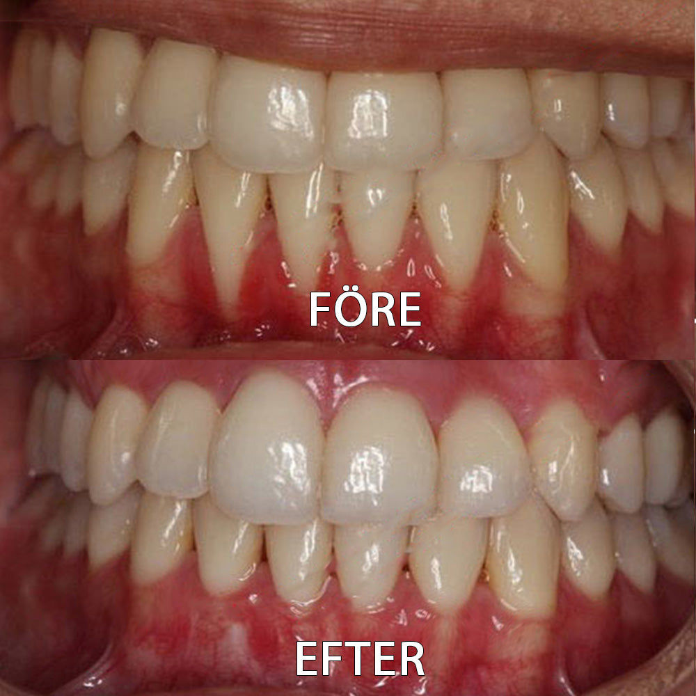â
đšđ»ââïžOfficiell butik | Ourlyardâą Tooth Health Mineral Powderđšđ»ââïžHar erhĂ„llit certifiering frĂ„n LĂ€kemedelsverket (Behandlar parodontit och munsĂ„r, förhindrar tandförlust och reparerar tillbakadraget tandkött)