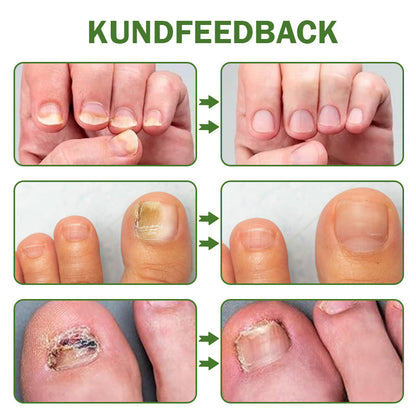 👨‍⚕️Furzero™ Nagelförsvar Bivensbehandlingsserum(För alla typer av nagelsjukdomar✅För hälsosammare nageltillväxt)